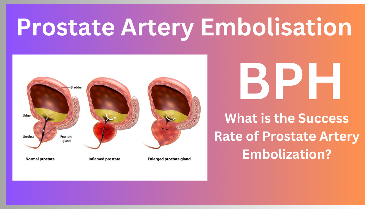 Prostate Artery Embolization (PAE): A Revolutionary Treatment ...